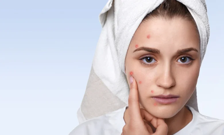 Home remedies for pimples